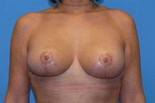after breast lift with augmentation front view Coral Gables, FL Gables Plastic Surgery