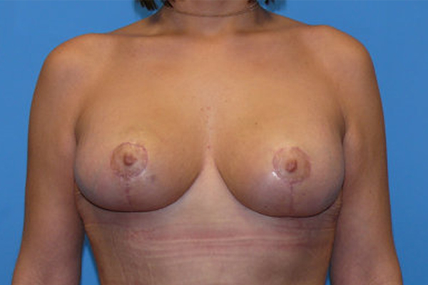 after breast lift with augmentation front view Coral Gables, FL Gables Plastic Surgery