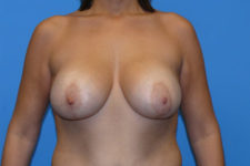 before breast lift with augmentation front view Coral Gables, FL Gables Plastic Surgery