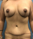 after mommy makeover front view Coral Gables, FL Gables Plastic Surgery