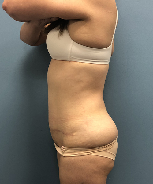 after tummy tuck left side view Coral Gables, FL Gables Plastic Surgery
