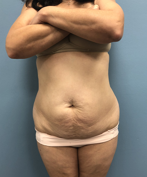 before tummy tuck front view Coral Gables, FL Gables Plastic Surgery