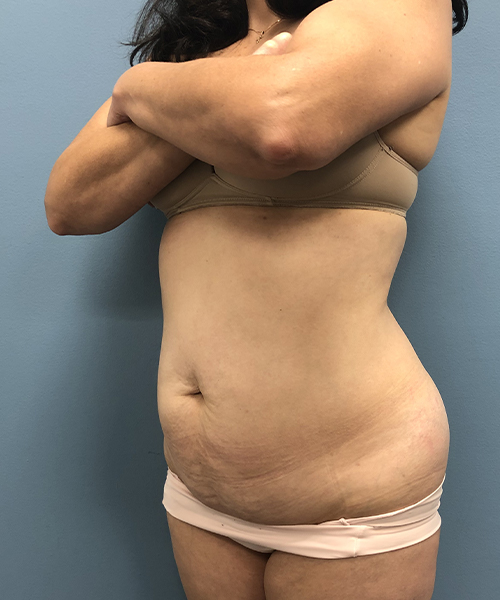before tummy tuck left angle view Coral Gables, FL Gables Plastic Surgery