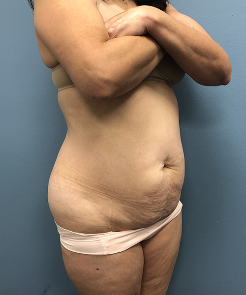 before tummy tuck right angle view Coral Gables, FL Gables Plastic Surgery