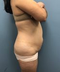before tummy tuck right side view Coral Gables, FL Gables Plastic Surgery