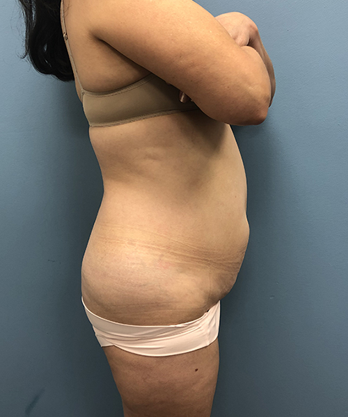 before tummy tuck right side view Coral Gables, FL Gables Plastic Surgery