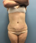 after tummy tuck front view Coral Gables, FL Gables Plastic Surgery