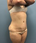 after tummy tuck right angle view Coral Gables, FL Gables Plastic Surgery