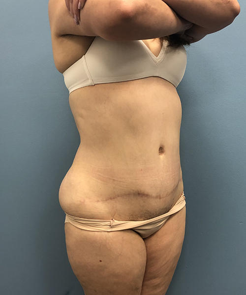 after tummy tuck right angle view Coral Gables, FL Gables Plastic Surgery