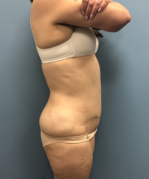 after tummy tuck right side view Coral Gables, FL Gables Plastic Surgery