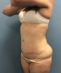 after tummy tuck left angle view Coral Gables, FL Gables Plastic Surgery