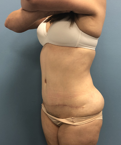 after tummy tuck left angle view Coral Gables, FL Gables Plastic Surgery