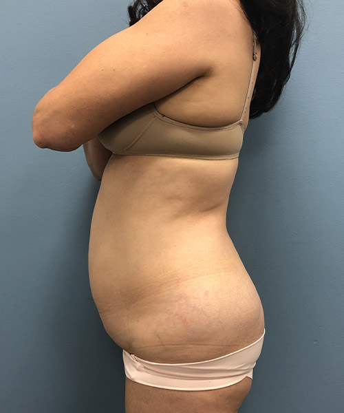 before tummy tuck left side view Coral Gables, FL Gables Plastic Surgery